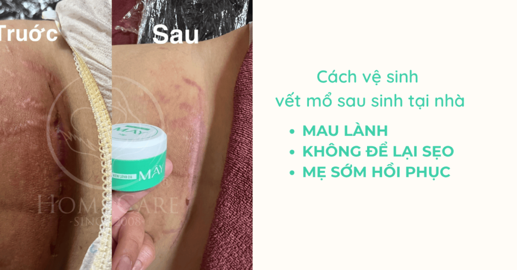 Cách vệ sinh vết mổ sau sinh tại nhà: Giúp mẹ lành nhanh, không để lại sẹo