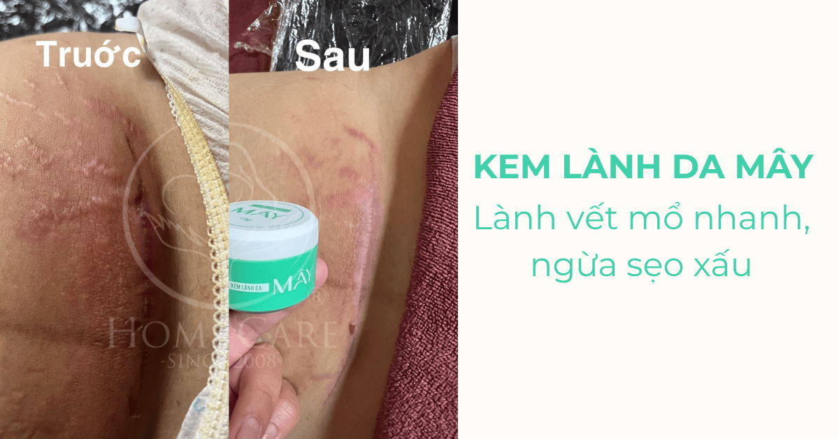 kem-lanh-vet-mo-sau-sinh-kem-lanh-da-may-home-care