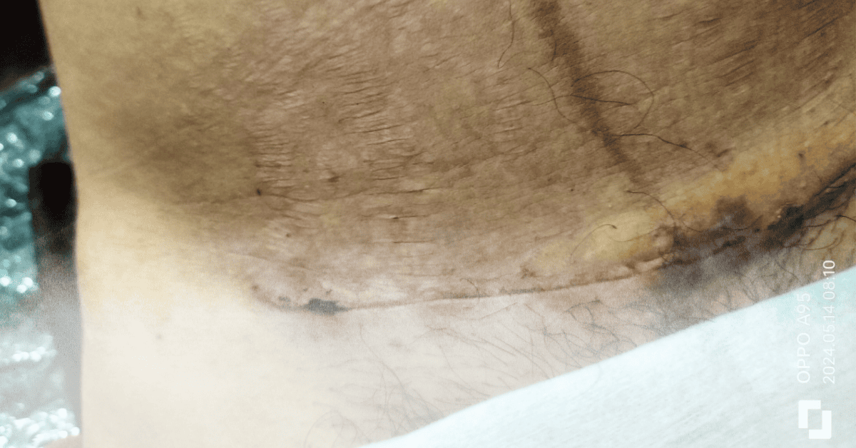 Những sai lầm khi vệ sinh vết mổ tại nhà khiến vết mổ lâu lành – Mẹ đừng chủ quan!